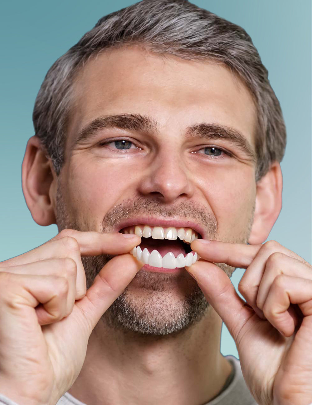 Veneera-Zahn-Veneers-002